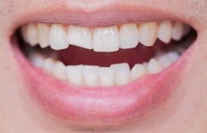 Chipped Tooth