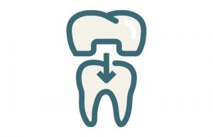Dental Crowns Bridges