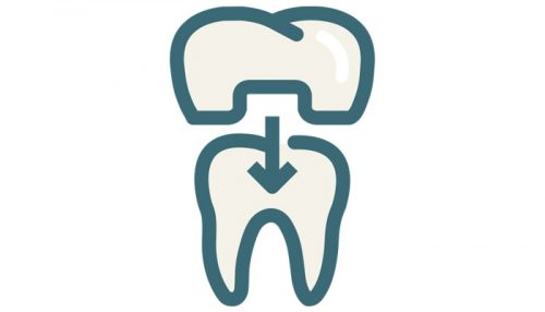 Dental Crowns Bridges