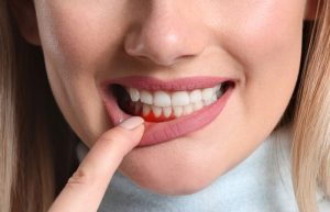 Gum Disease