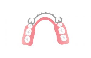 Partial Dentures