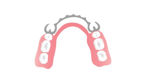 Partial Dentures