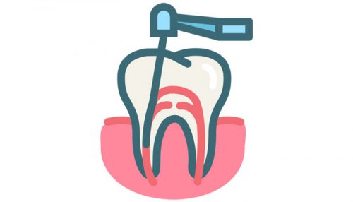 Root Canal