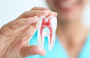 Root Canal