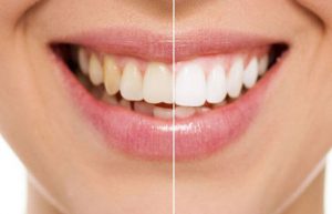 Teeth Discoloration