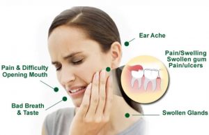 Wisdom Teeth