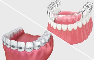 Braces and Invisalign