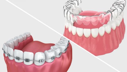 Braces and Invisalign