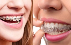 Braces and Invisalign