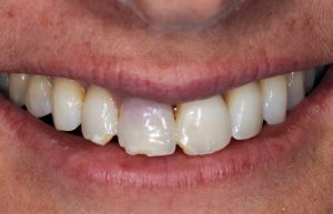 Chipped Tooth Problem