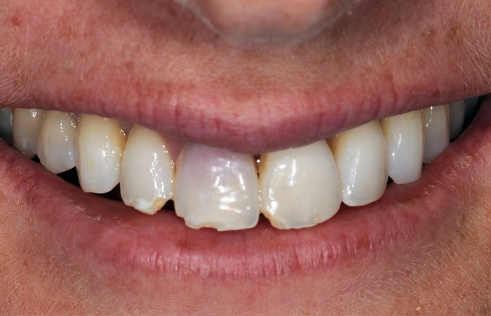 Chipped or Cracked Tooth Causes and Repair - Crest