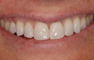 Chipped Tooth Solution