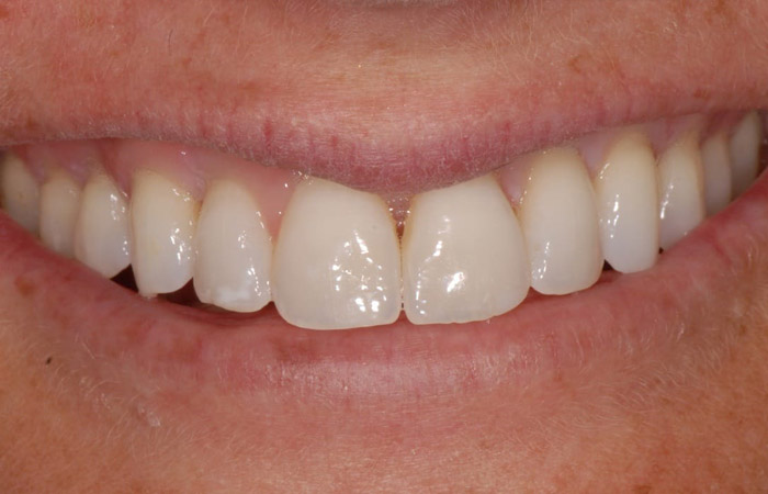 Chipped Tooth Solution