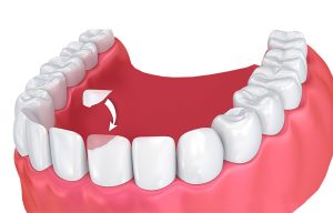 Dental Bonding