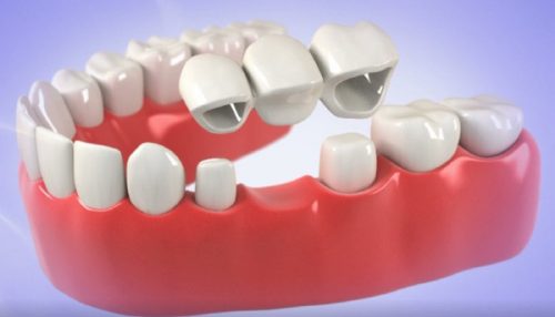 Dental Bridges