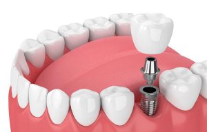 Dental Implant