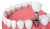 Dental Implant
