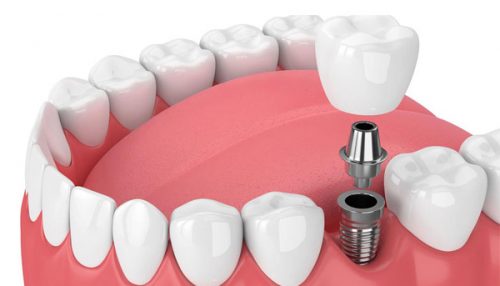 Dental Implant