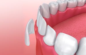 Dental Veneer