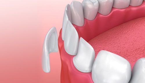 Dental Veneer