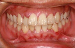 Gum Disease Problem