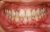 Gum Disease Problem