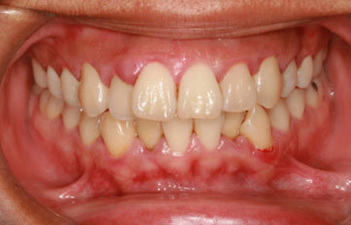 Gum Disease Problem