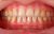Gum Disease Solution