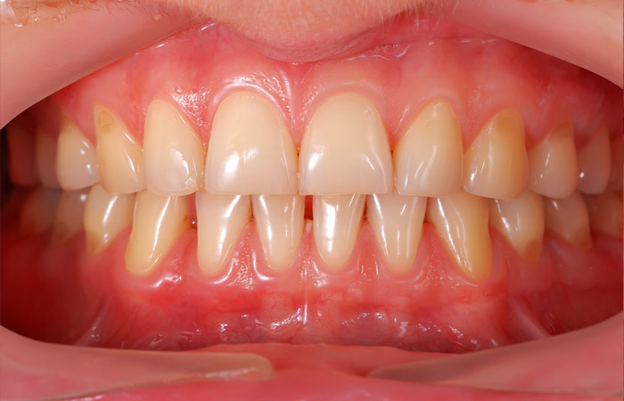 Gum Disease Solution