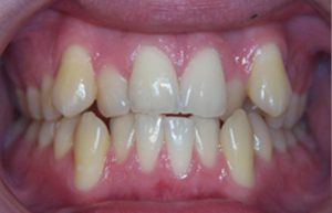 Malocclusion Problem