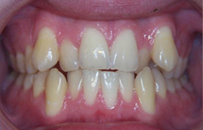 Malocclusion Problem