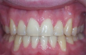 Malocclusion Solution