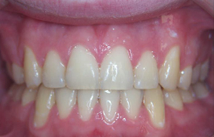 Malocclusion Solution