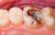Root Canal Problem