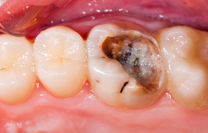 Root Canal Problem