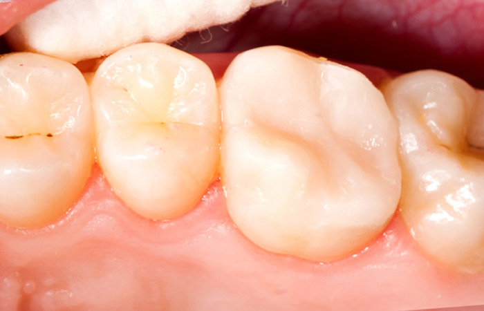 Root Canal Solution