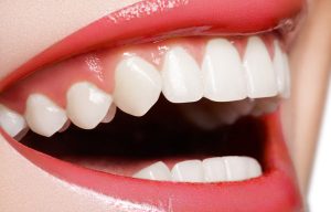 Smile Makeover