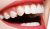 Smile Makeover