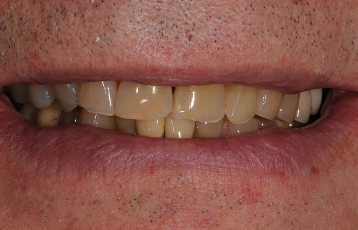 Teeth Discoloration Problem