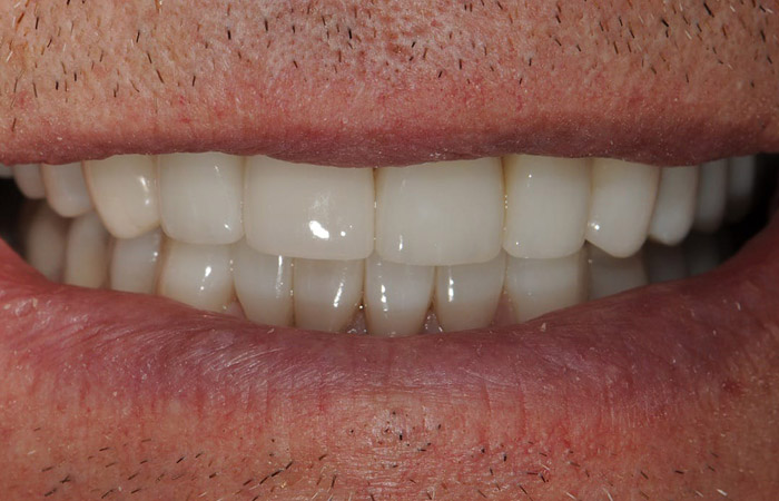 Teeth Discoloration Solution