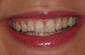 Tooth Discoloration Problem