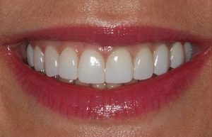 Tooth Discoloration Solution