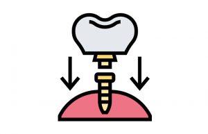 Dental Implant