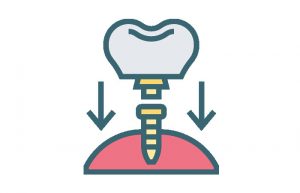 Dental Implant