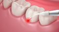What is Laser Dentistry?