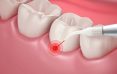 What is Laser Dentistry?