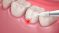 What is Laser Dentistry?