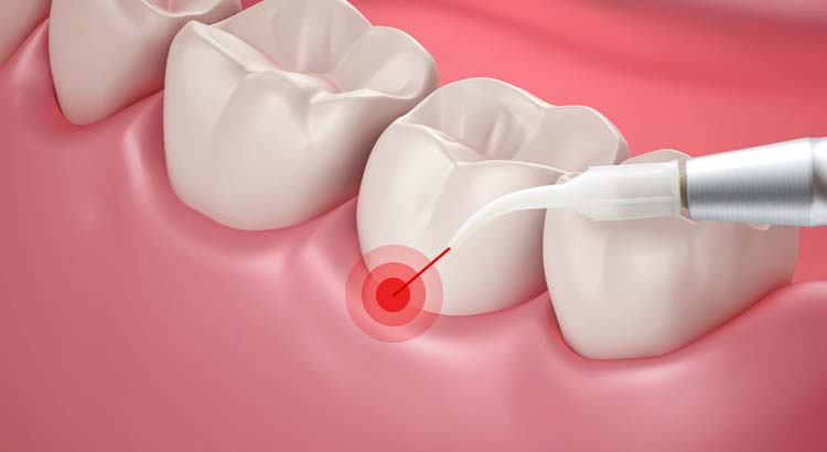 What is Laser Dentistry?