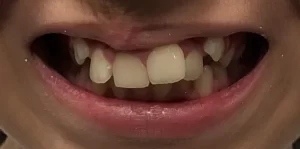 naperville cosmetic dentist - dental braces & Invisalign