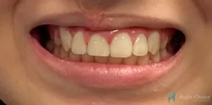 naperville cosmetic dentist - dental braces & Invisalign